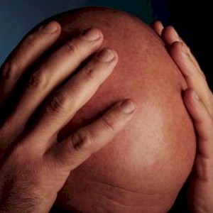 how you should embrace your baldness