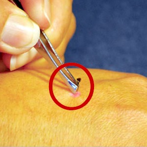 how to rid of tick bites